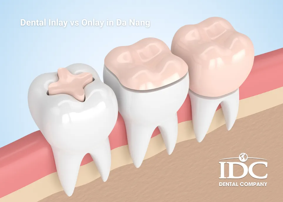 Dental Inlay vs Onlay in Da Nang