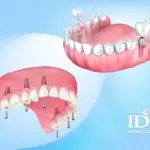 Price list for dental implant packages in Da Nang City