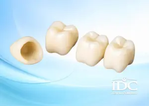 Price list for dental implant packages in Da Nang City (Updated 2026)