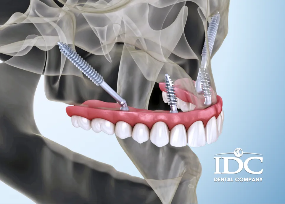 Zygoma Implant in Da Nang 2