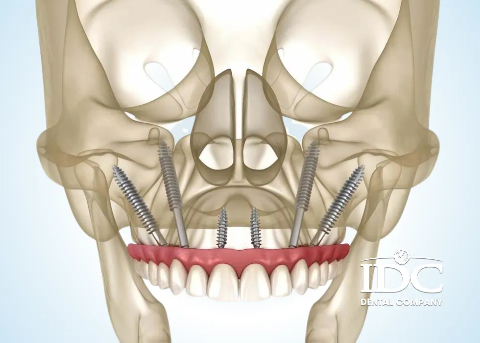 Why Choose Zygoma Implants Instead of Bone Grafting?