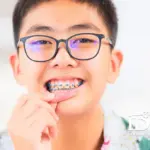 Có nên niềng răng cho trẻ 11 tuổi không?