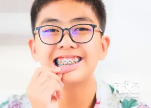 Trồng răng implant All-on-4 là gì? Giá bao nhiêu tại Đà Nẵng?