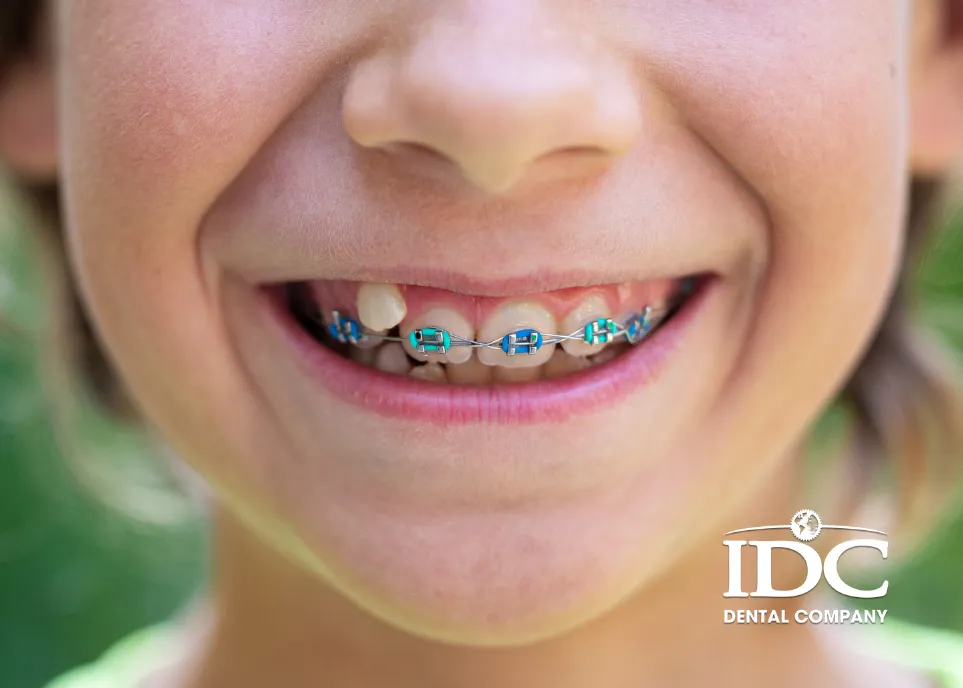 Có nên niềng răng khểnh không?