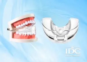 Lợi ích của việc niềng răng là gì? 7 Điều bạn nên biết