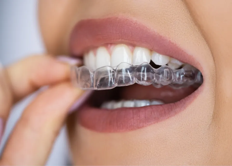 Tính thẩm mỹ của niềng răng invisalign gần như “vô hình”