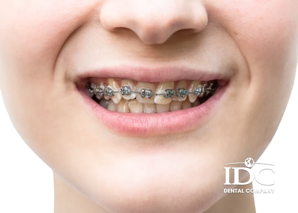 Lệch hàm có niềng răng được không?