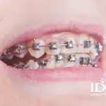 lech ham co nieng rang duoc khong 2