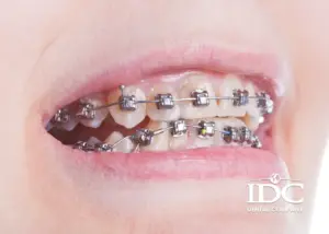 Lợi ích của việc niềng răng là gì? 7 Điều bạn nên biết