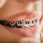 Lắp răng sứ có niềng răng được không?