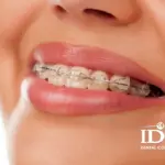 Lợi ích của việc niềng răng