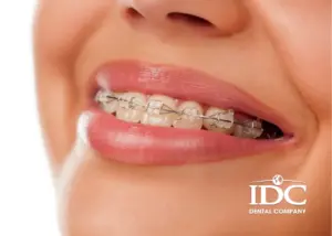 Có nên niềng răng mặt trong không? Giải pháp thẫm mỹ tối ưu