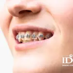 Lưu ý khi niềng răng cho trẻ để đặt hiệu quả tốt