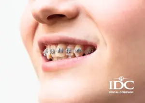 Có nên niềng răng mắc cài sứ không? Ưu nhược điểm và chi phí