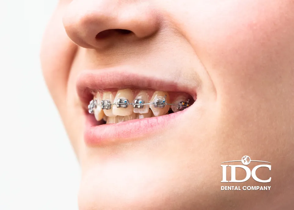 Lưu ý khi niềng răng cho trẻ để đặt hiệu quả tốt