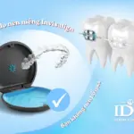ly do nen nieng rang invisalign khong nen bo qua