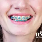 Nên niềng răng khi lớn tuổi không?