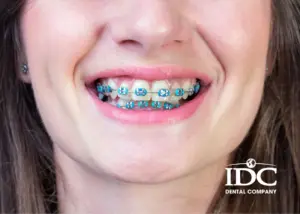 Nên niềng răng khi lớn tuổi không?