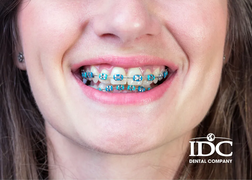 Nên niềng răng khi lớn tuổi không?