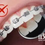 Những người không nên niềng răng