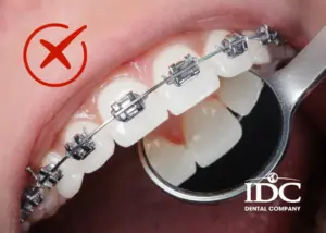 Lưu ý sau khi tháo niềng răng: Cách giữ răng không bị chạy lại