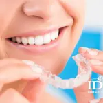 Niềng trong suốt Invisalign bao lâu có kết quả?