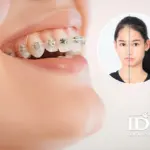 nieng rang co bi lech mat khong