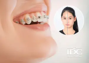 Bọc răng sứ đau bao lâu là bình thường ? Khi nào cần kiểm tra?