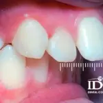 Chi phí niềng răng hô nặng bao nhiêu?