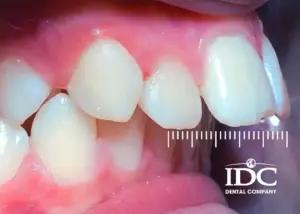 Có nên niềng răng cho trẻ em không? Bác sĩ giải đáp