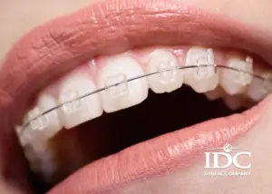 Có nên niềng răng mặt trong không? Giải pháp thẫm mỹ tối ưu