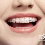 Có nên niềng răng mắc cài sứ không?