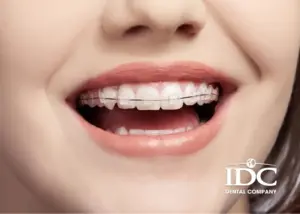 7 Lưu ý khi niềng răng cho trẻ để đặt hiệu quả tốt (từ 6 – 12 tuổi)