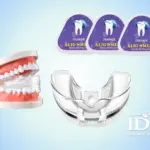 Có nên niềng răng tại nhà không?