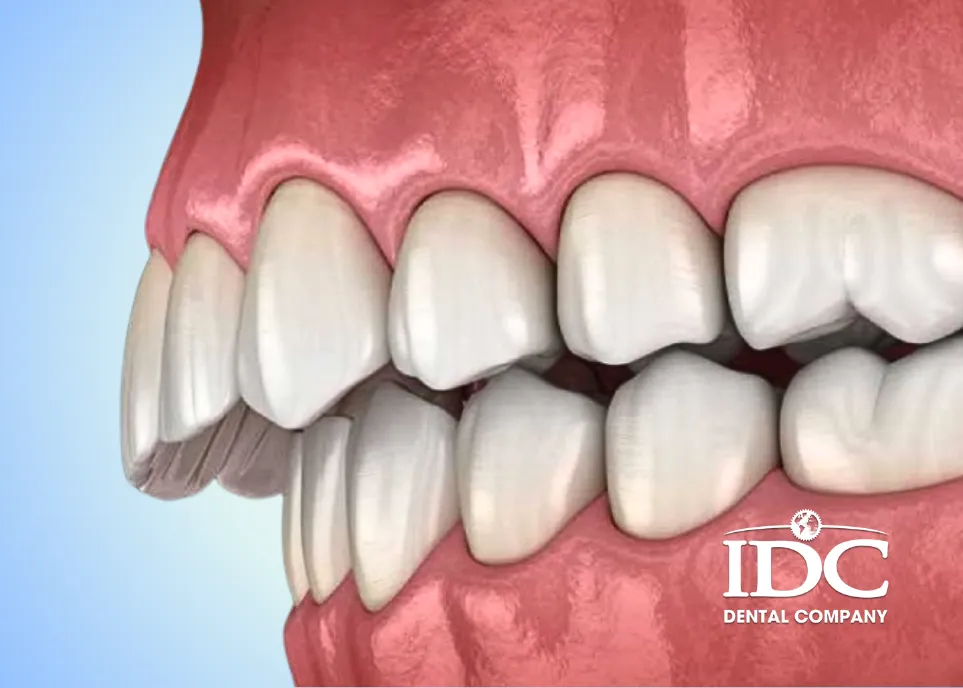 Quy trình niềng răng hô nhẹ chuẩn y khoa