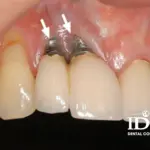 Tác hại khi trồng răng implant sai kỹ thuật