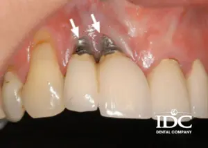 Tác hại khi trồng răng implant sai kỹ thuật