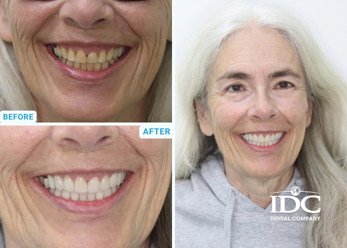 Dental Crown 3
