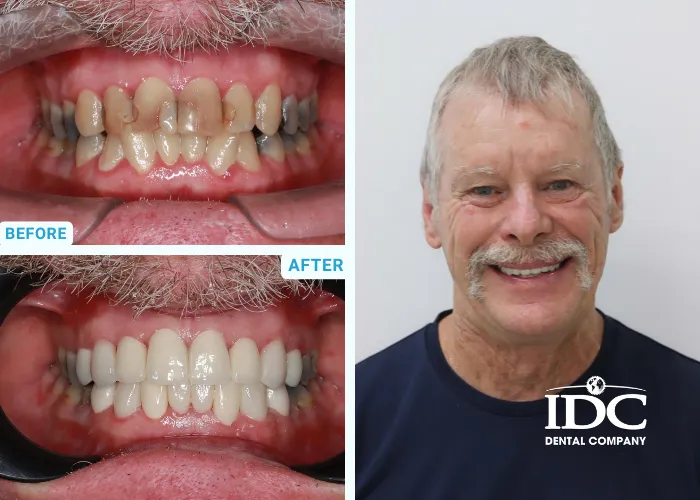 Dental Crown 4
