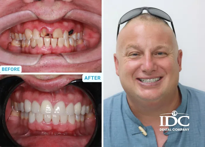 Dental Crown 5 1