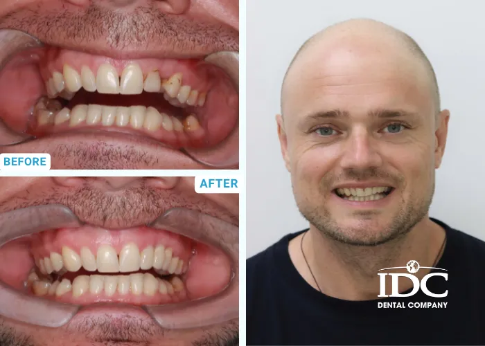 Dental Crown 5