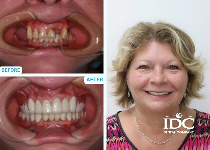 Dental Crown 6