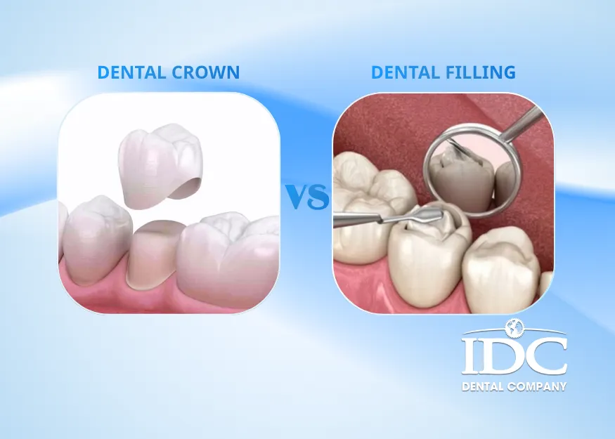 Dental Crown vs Dental Filling