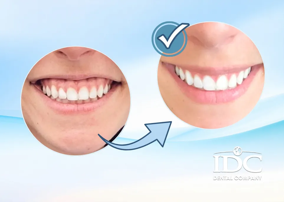 Common Causes of a Gummy Smile