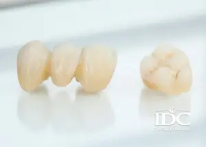 How long do porcelain crowns last?