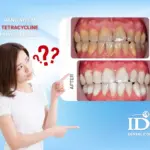 Rang nhiem tetracycline