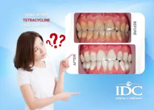Răng bị nứt phải làm sao? 4 Cách khắc phục hiệu quả