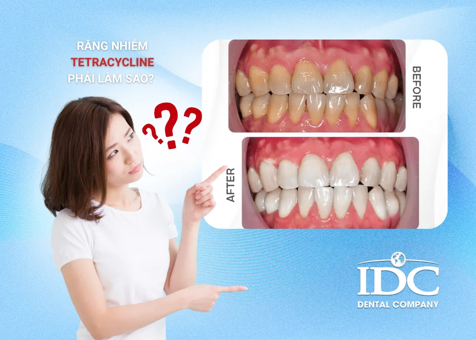Rang nhiem tetracycline