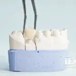 Types of Dental Crowns