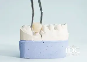 Dental Crown vs Dental Filling: Which Treatment Do You Need?